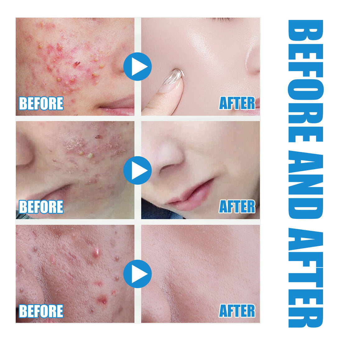 Hyaluronic Acid Replenishment